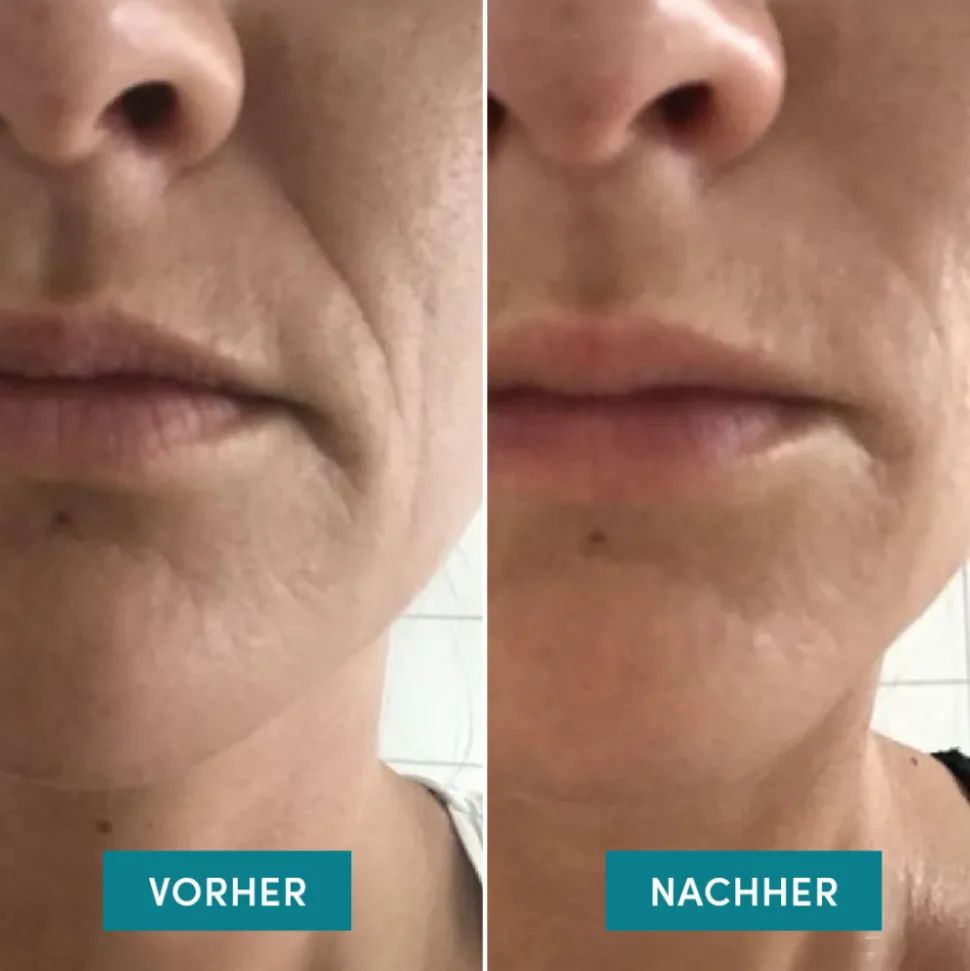 APRICOT Mund Patches mit Niacinamide