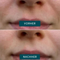 APRICOT Mund Patches mit Panthenol 100 Stück