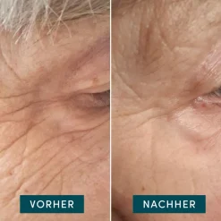 Apricot Wiederverwendbare Augen-Schläfen Pads mit Hyaluron