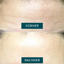 APRICOT Wiederverwendbares Stirn Pad mit Hyaluron