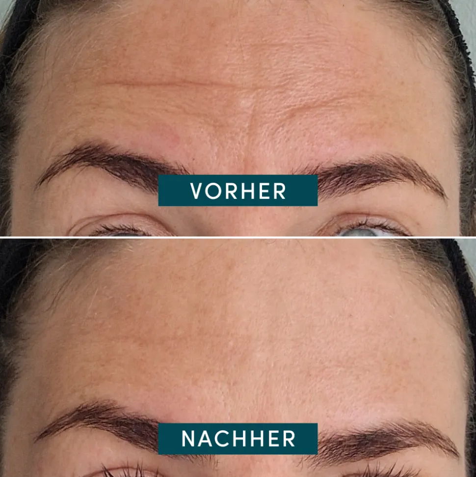 APRICOT Wiederverwendbares Stirn-Pad mit Ectoin