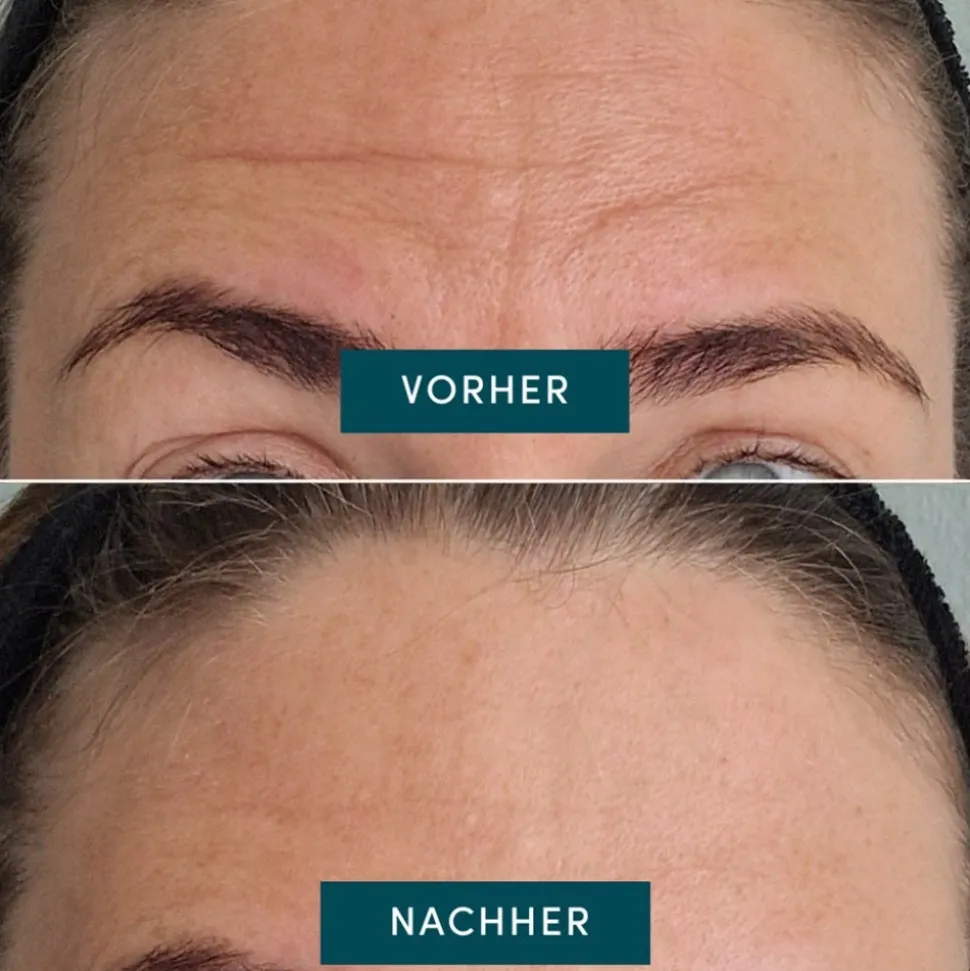 Apricot Wiederverwendbares Stirn Pad mit Vitamin C