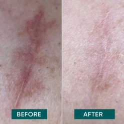 APRICOT Wiederverwendbare Narben Pads mit Aloe Vera