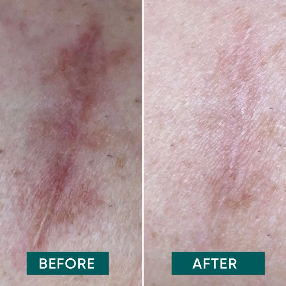 APRICOT Wiederverwendbare Narben Pads mit Aloe Vera